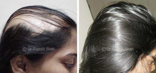 Alopecia Areata Before and After Case Photo