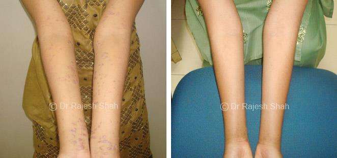 Lichen Planus Before and After Case Photo