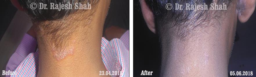 Psoriasis Before and After Case Photo