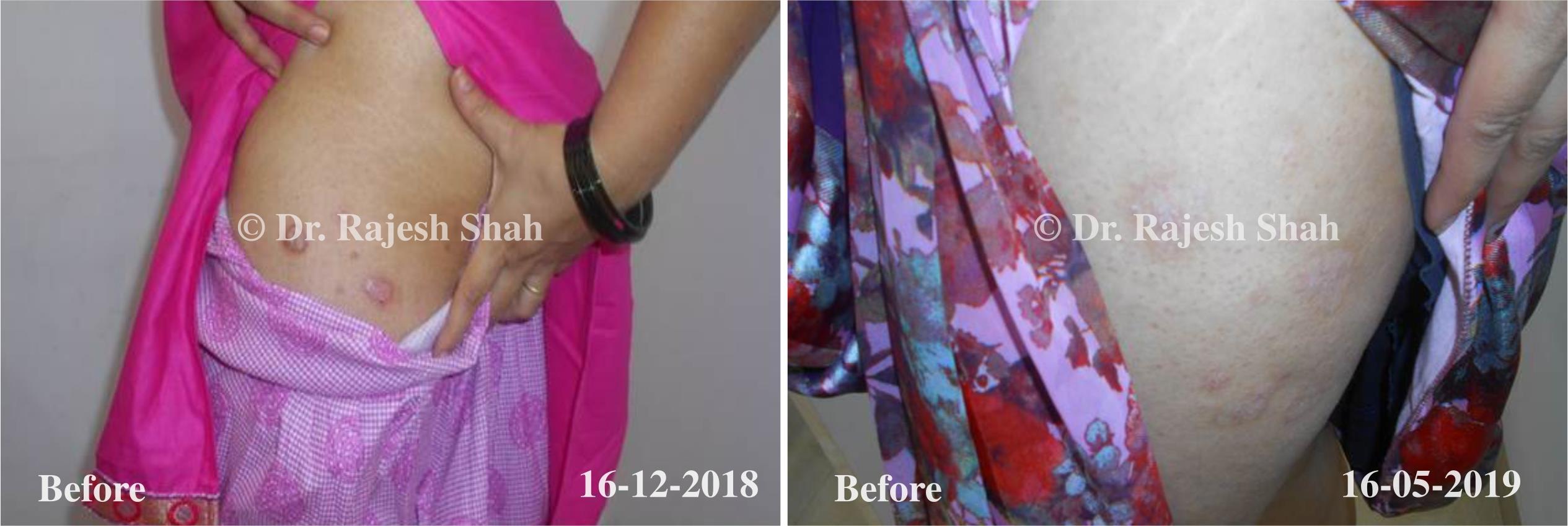 Psoriasis Before and After Case Photo