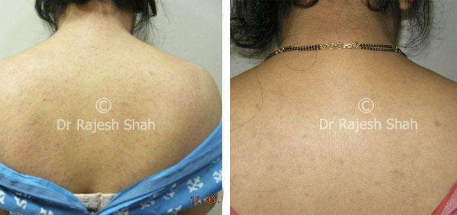 Lichen Planus Before and After Case Photo