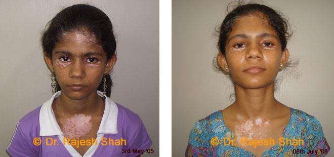 Vitiligo Before and After Case Photo