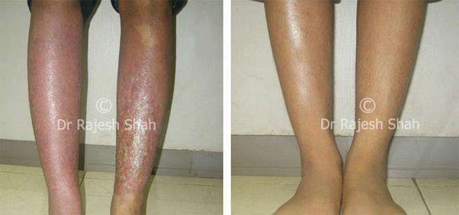 Eczema Before and After Case Photo