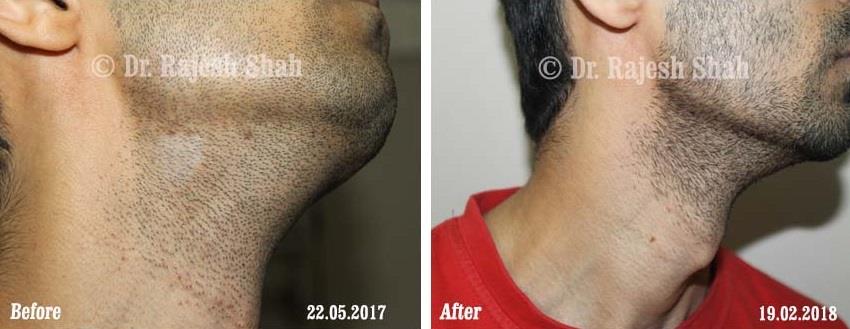 Vitiligo Before and After Case Photo