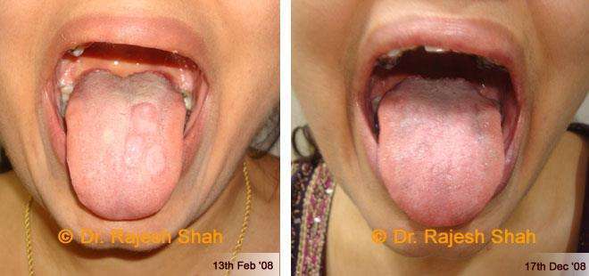 Lichen Planus Before and After Case Photo
