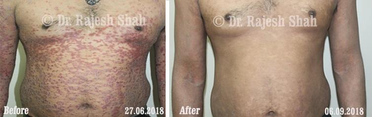 Psoriasis Before and After Case Photo