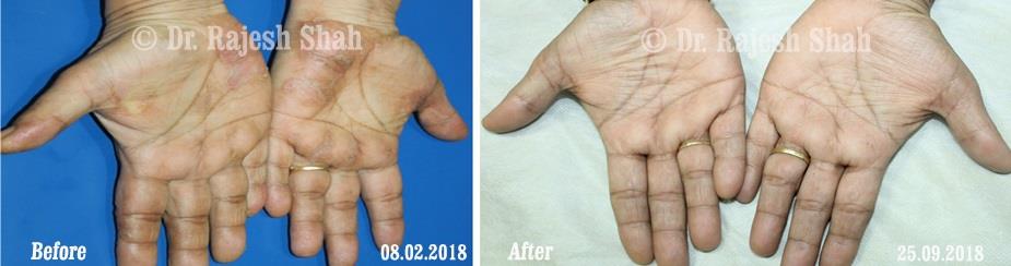 Psoriasis Before and After Case Photo
