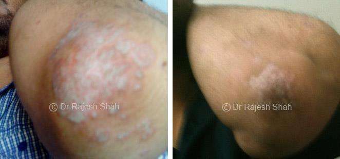 Psoriasis Before and After Case Photo