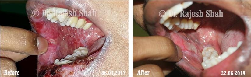 Lichen Planus Before and After Case Photo