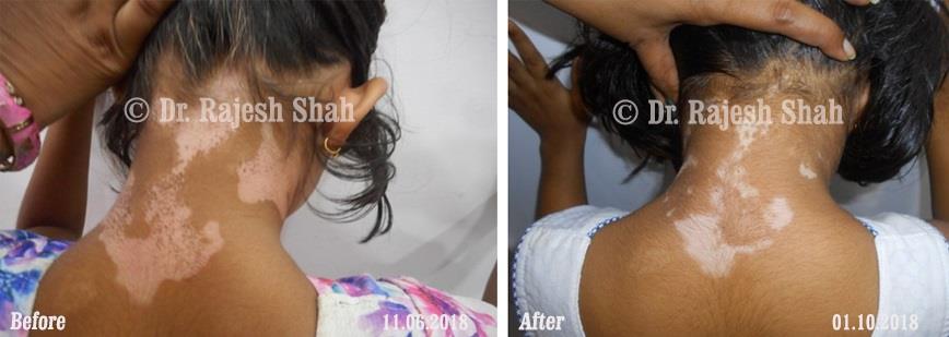 Vitiligo Before and After Case Photo