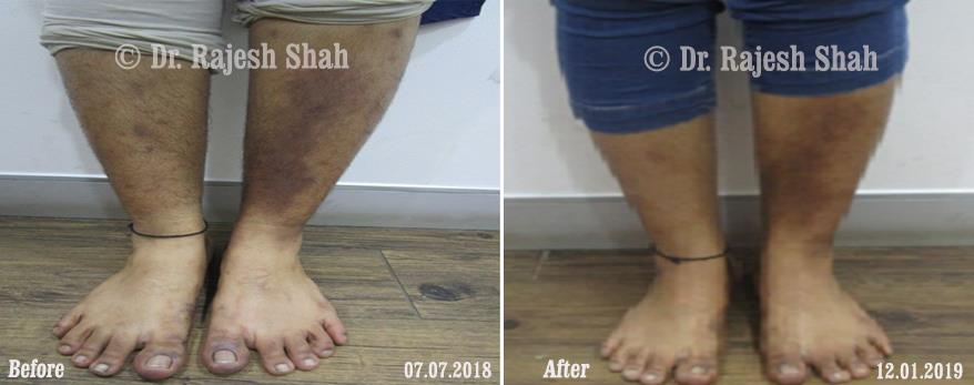 Psoriasis Before and After Case Photo