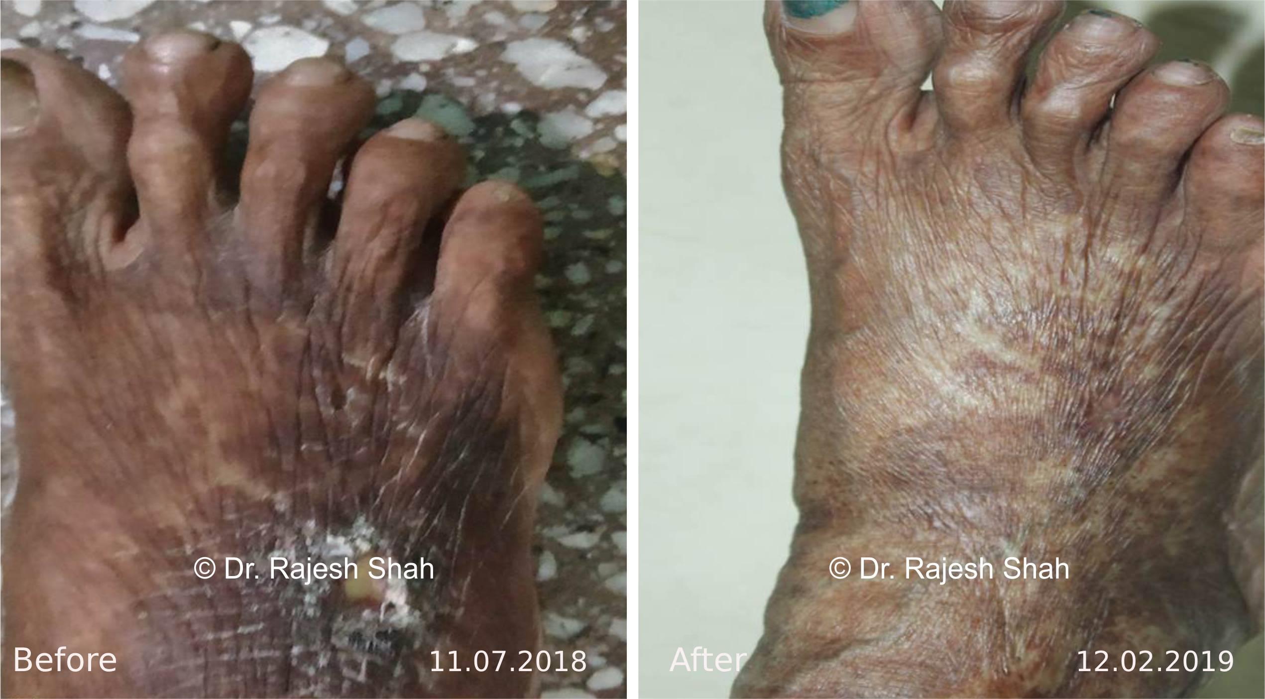 Non-healing ulcers Before and After Case Photo
