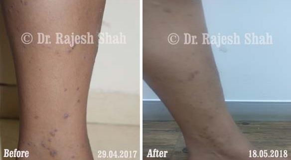 Lichen Planus Before and After Case Photo