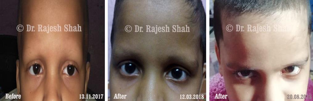 Alopecia Areata Before and After Case Photo