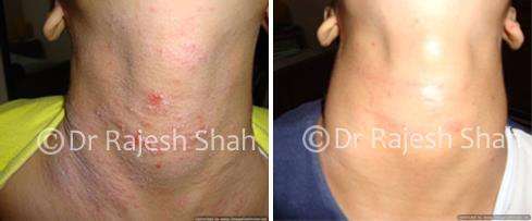 Atopic Dermatitis Before and After Case Photo