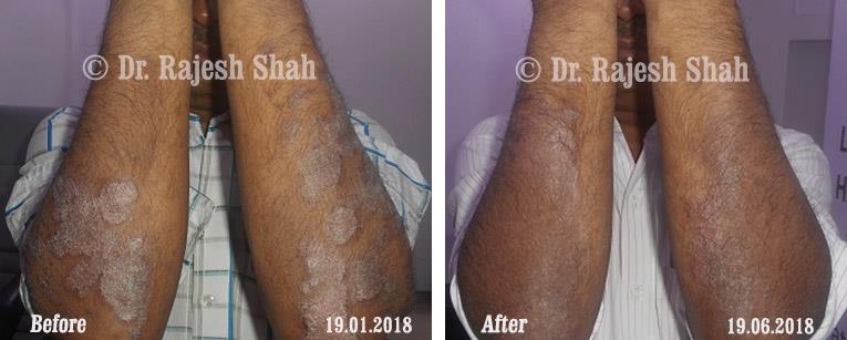 Psoriasis Before and After Case Photo