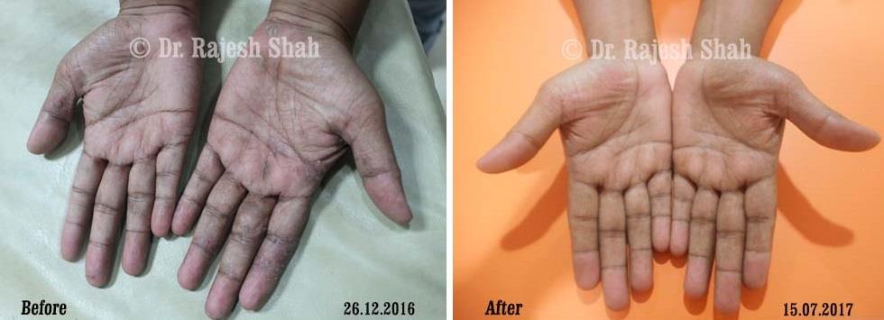 Psoriasis Before and After Case Photo