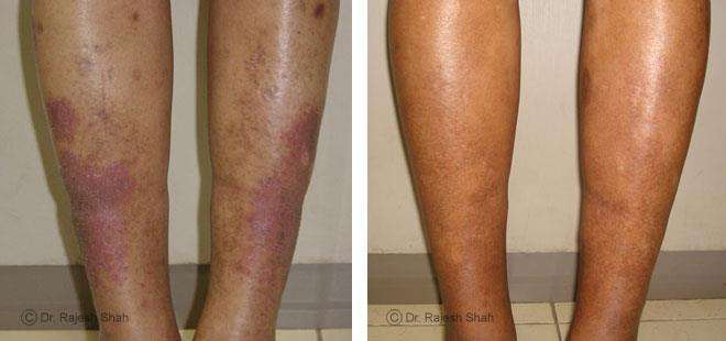 Psoriasis Before and After Case Photo