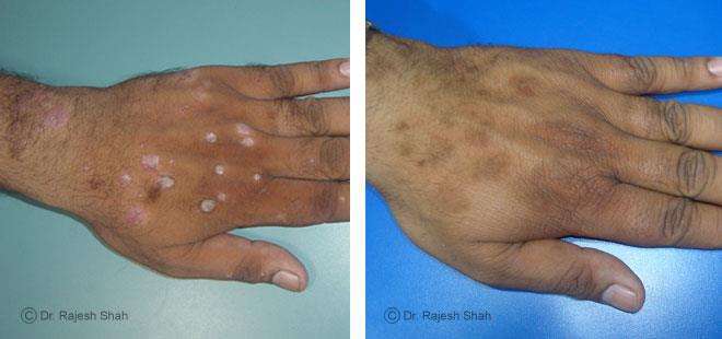 Psoriasis Before and After Case Photo