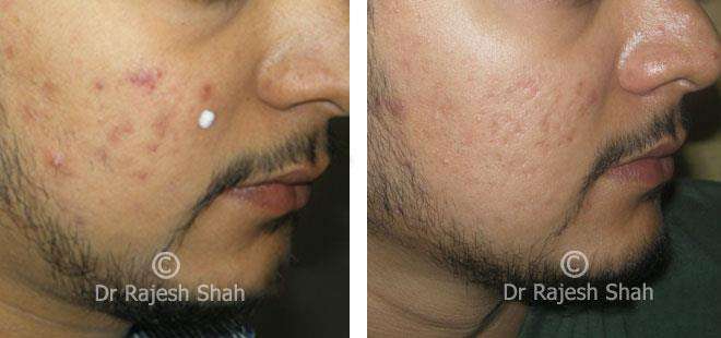 Hair loss Before and After Case Photo