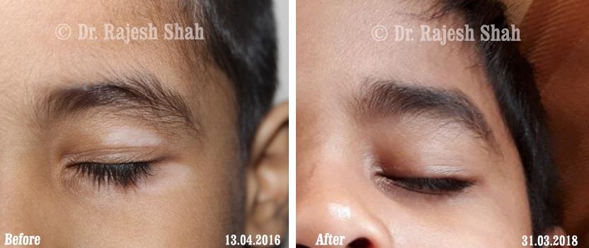 Vitiligo Before and After Case Photo