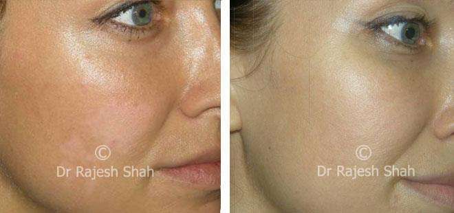 Vitiligo Before and After Case Photo