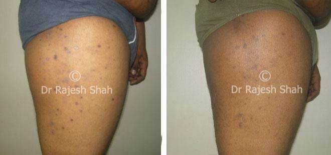 Lichen Planus Before and After Case Photo