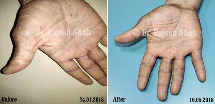 Atopic Dermatitis Before and After Case Photo