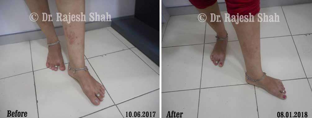 Psoriasis Before and After Case Photo