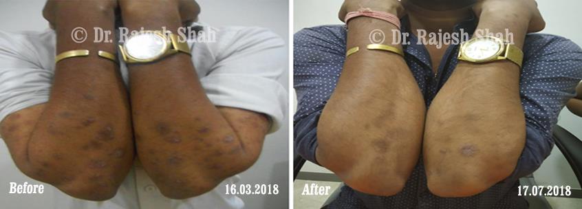 Psoriasis Before and After Case Photo