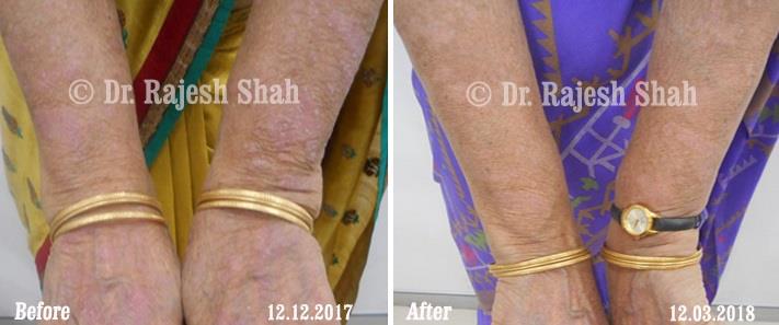 Psoriasis Before and After Case Photo