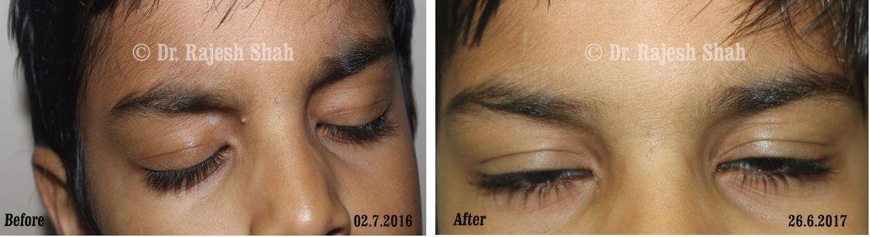 Vitiligo Before and After Case Photo