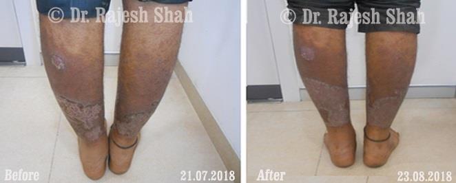 Psoriasis Before and After Case Photo