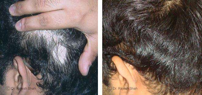 Alopecia Areata Before and After Case Photo