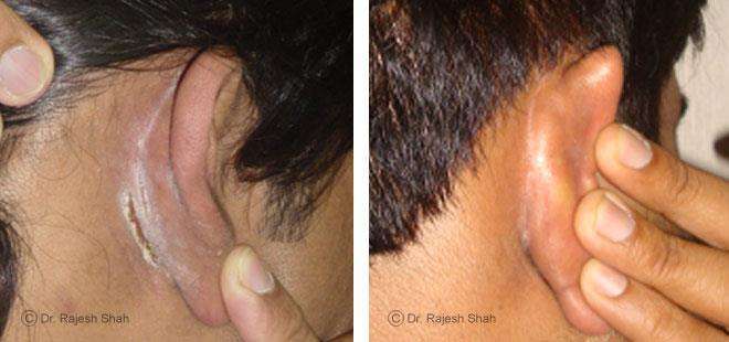 Psoriasis Before and After Case Photo