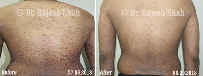 Psoriasis Before and After Case Photo