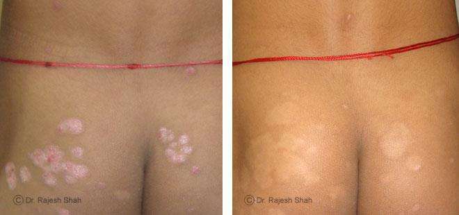 Psoriasis Before and After Case Photo