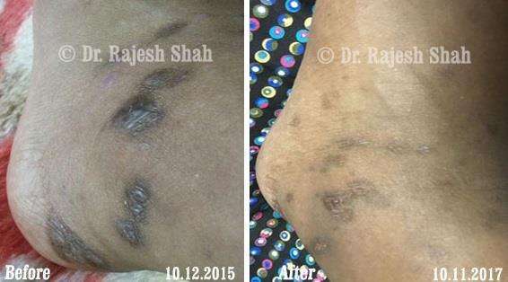 Lichen Planus Before and After Case Photo