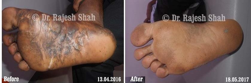 Psoriasis Before and After Case Photo