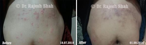 Lichen Planus Before and After Case Photo