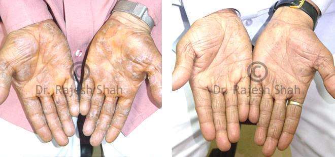 Psoriasis Before and After Case Photo