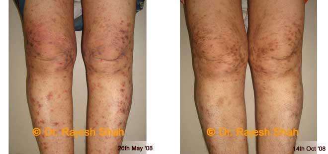 Lichen Planus Before and After Case Photo