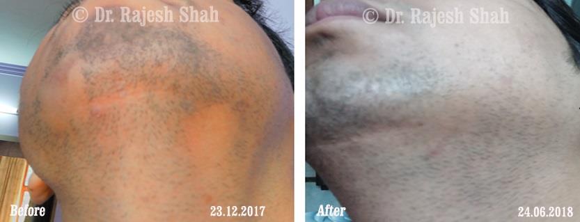 Alopecia Areata Before and After Case Photo