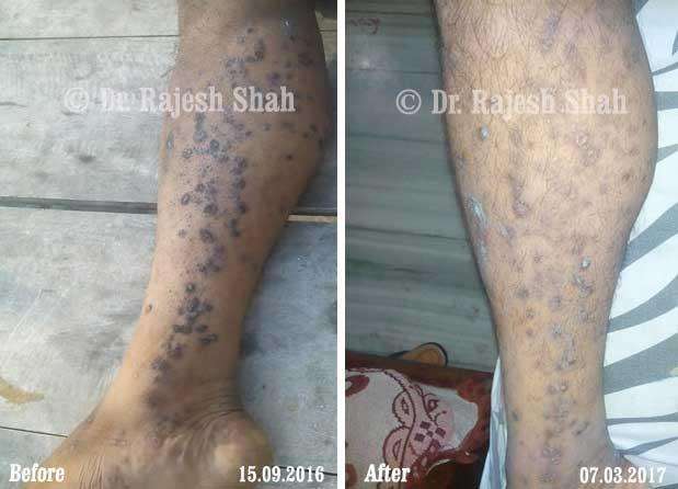 Lichen Planus Before and After Case Photo