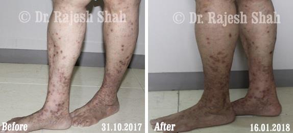 Lichen Planus Before and After Case Photo