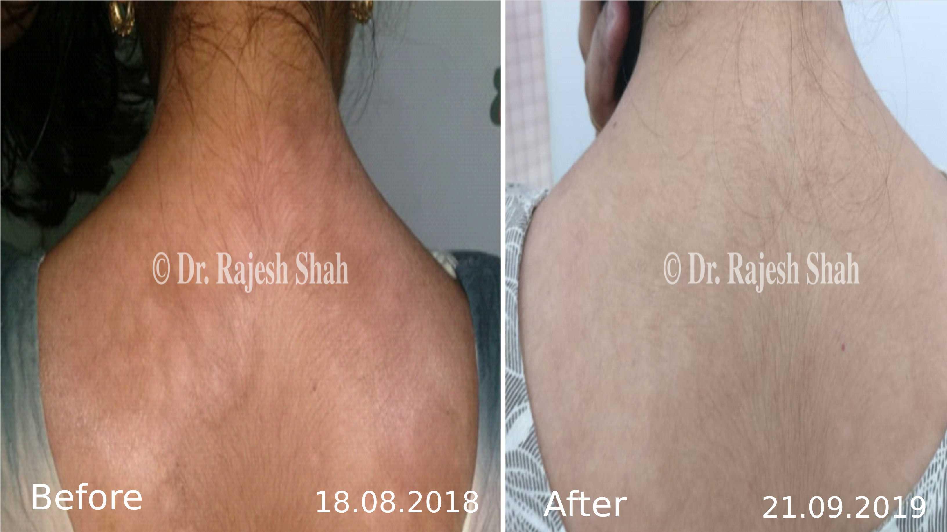 Psoriasis Before and After Case Photo