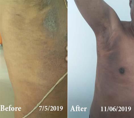 Eczema Before and After Case Photo