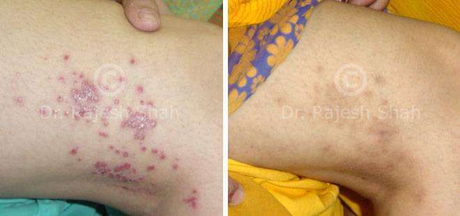 Eczema Before and After Case Photo