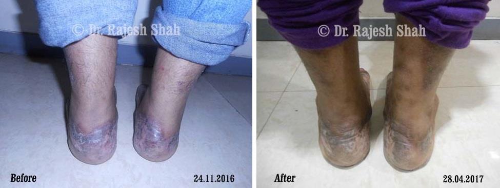 Psoriasis Before and After Case Photo