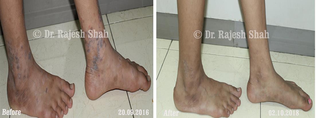 Lichen Planus Before and After Case Photo